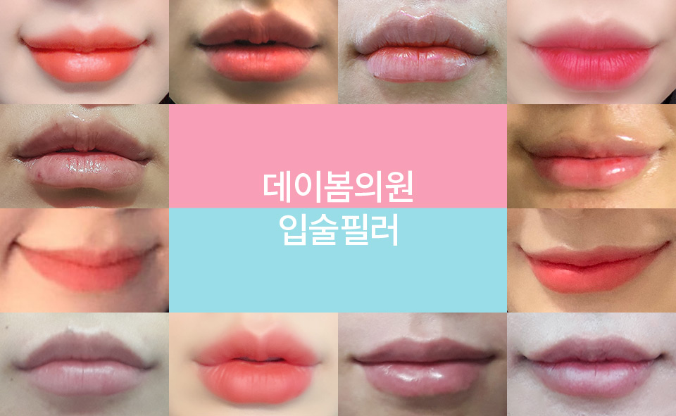 입술필러